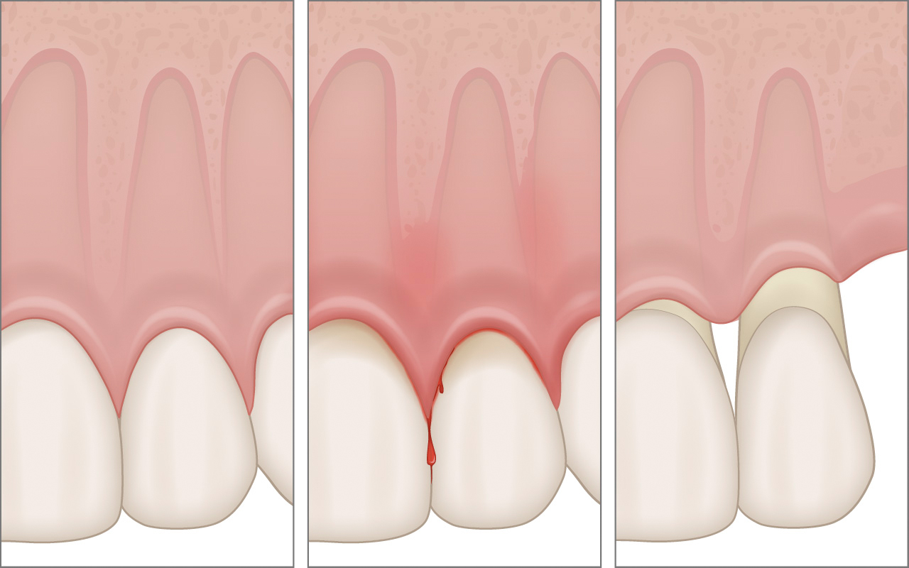 What is Periodontitis and how common is it?