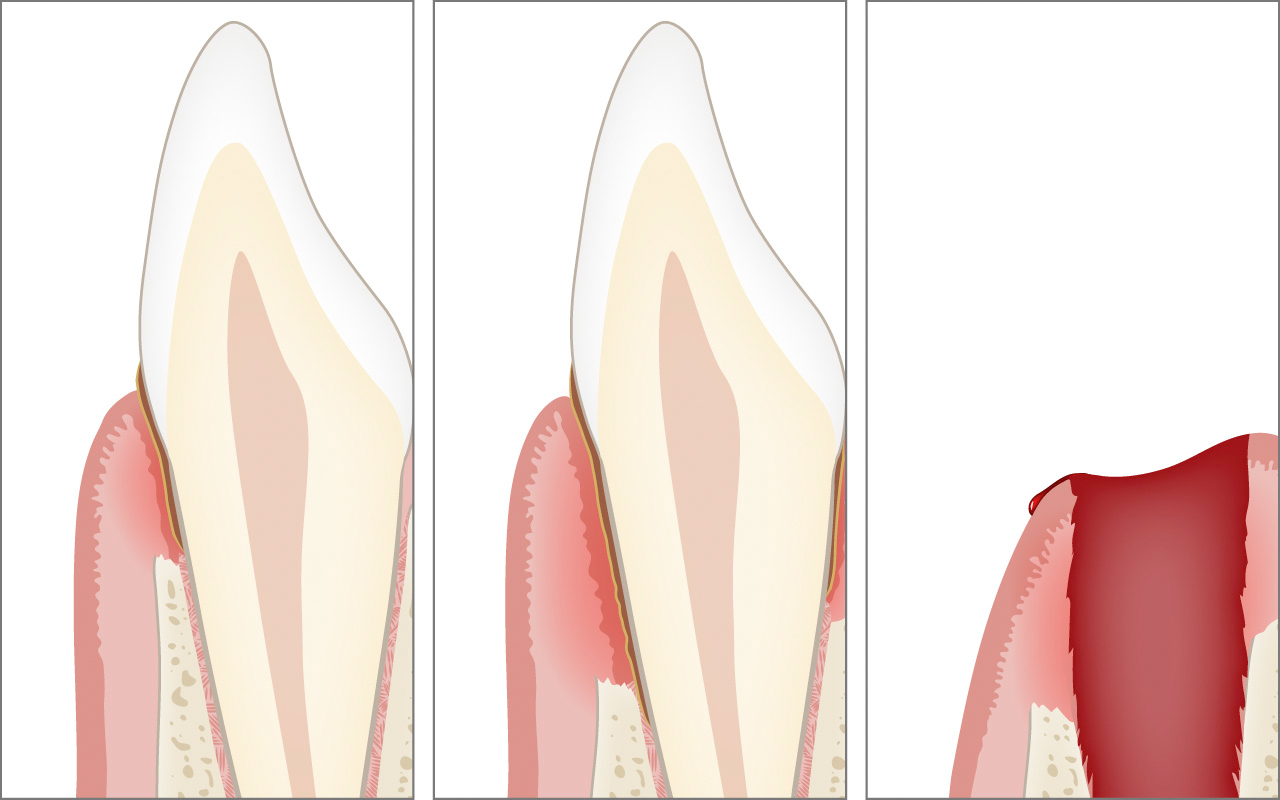 Further consequences include bone loss, periodontal pockets, and tooth loss